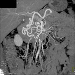 Median Arcuate Ligament Syndrome -MALS - CTisus CT Scan