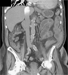 Slow Flow Inferior Vena Cava (IVC) - CTisus CT Scan