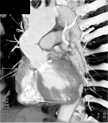 Aorta Repair in Marfan - CTisus CT Scan