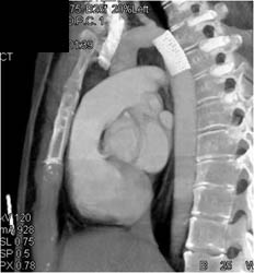 Stent in Patient With Coa - CTisus CT Scan