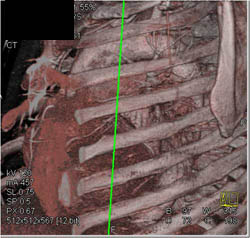 Pre-op CT for Coronary Artery Bypass Graft (CABG) Redo - CTisus CT Scan