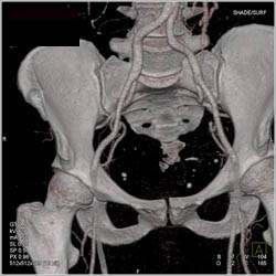 Gluteal Perforators - CTisus CT Scan