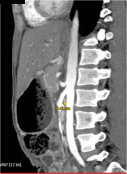 Superior Mesenteric Artery (SMA) Syndrome - CTisus CT Scan