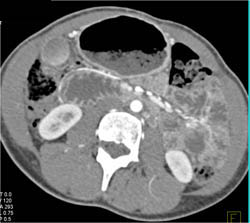 Superior Mesenteric Artery (SMA) Syndrome - CTisus CT Scan