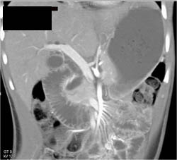 Superior Mesenteric Artery (SMA) Syndrome - CTisus CT Scan