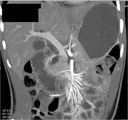 Superior Mesenteric Artery (SMA) Syndrome - CTisus CT Scan