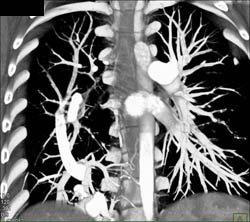 Scimtar Syndrome - CTisus CT Scan