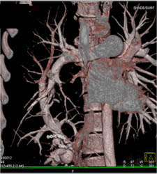 Scimitar Syndrome - CTisus CT Scan