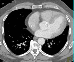 Diseased Aortic Valve - CTisus CT Scan