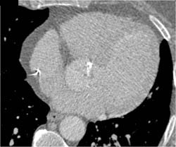 Diseased Aortic Valve - CTisus CT Scan