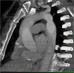 Coa - CTisus CT Scan