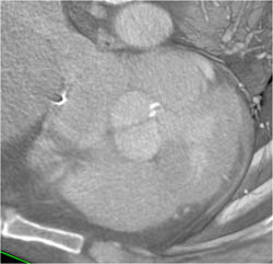 Bicuspid Valve in Coa - CTisus CT Scan