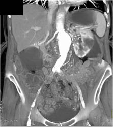 Abdominal Aortic Aneurysm (AAA) - CTisus CT Scan