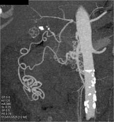 Arterial Collaterals Due to Celiac Occlusion - CTisus CT Scan