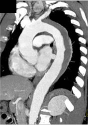 Intramural Hematoma- See Sequence - CTisus CT Scan