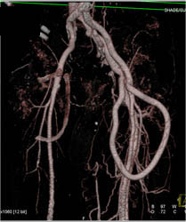 Av Fistulae - CTisus CT Scan