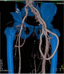 Av Fistulae - CTisus CT Scan