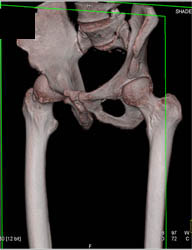 Av Fistulae - CTisus CT Scan