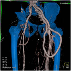 Av Fistulae - CTisus CT Scan