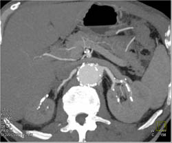 Renal Artery Disease - CTisus CT Scan