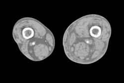 Av Fistulae - CTisus CT Scan