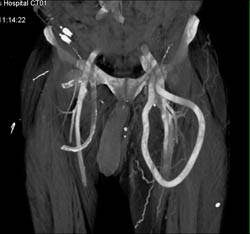 Av Fistulae - CTisus CT Scan