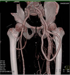 Av Fistulae - CTisus CT Scan