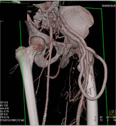 Av Fistulae - CTisus CT Scan