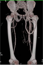 Av Fistulae - CTisus CT Scan