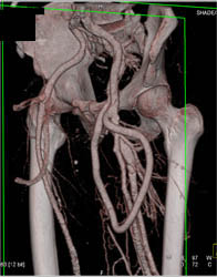 Av Fistulae - CTisus CT Scan