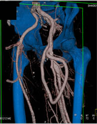 Av Fistulae - CTisus CT Scan