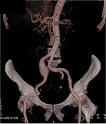 Iliac Artery Aneurysm - CTisus CT Scan