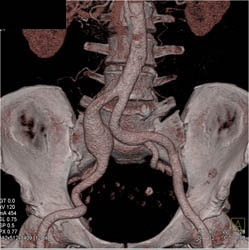 Iliac Artery Aneurysm - CTisus CT Scan