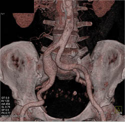 Iliac Artery Aneurysm - CTisus CT Scan