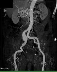 Iliac Artery Aneurysm - CTisus CT Scan