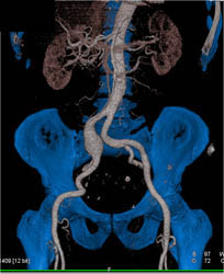 Iliac Artery Aneurysm - CTisus CT Scan