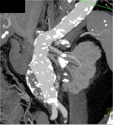 Abdominal Aortic Aneurysm (AAA) - CTisus CT Scan