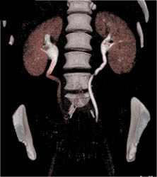 Left Ureter Displaced By Mass Effect - CTisus CT Scan