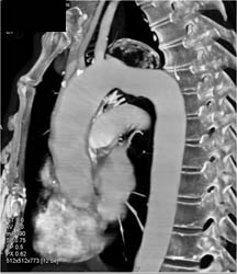 Aneurysm Off Arch - CTisus CT Scan