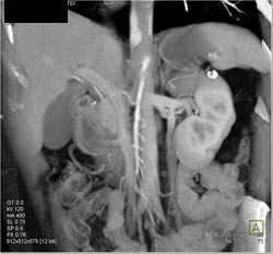 Splenic Artery Aneurysm - CTisus CT Scan