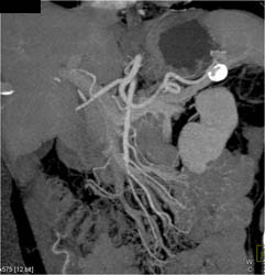 Splenic Artery Aneurysm - CTisus CT Scan