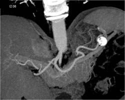 Splenic Artery Aneurysm - CTisus CT Scan