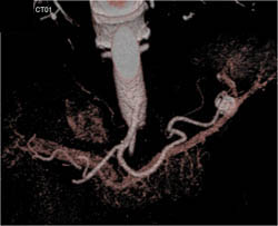 Splenic Artery Aneurysm - CTisus CT Scan