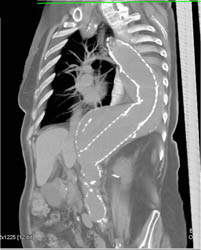 Endovascular Stent - CTisus CT Scan