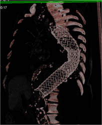 Endovascular Stent - CTisus CT Scan