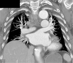 Dilated ???? Aorta With Pulmonary Arteriovenous Malformation (PAVM) - CTisus CT Scan