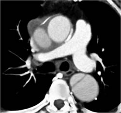 Type B Dissection - CTisus CT Scan