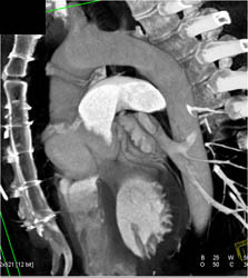 Ascending Aorta Repair With Dilated Sinus of Valsalva - CTisus CT Scan