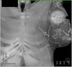 Arteriovenous Malformation (AVM) Axilla S/P Embolization With A Few Collaterals Still Present - CTisus CT Scan