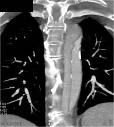 Aortic Dissection - CTisus CT Scan